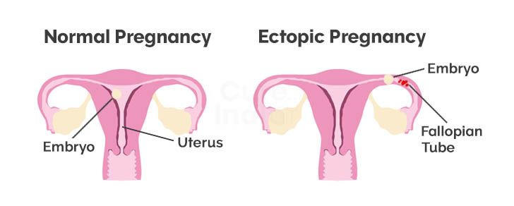 Ectopic Pregnancy -  causes of blocked fallopian tube